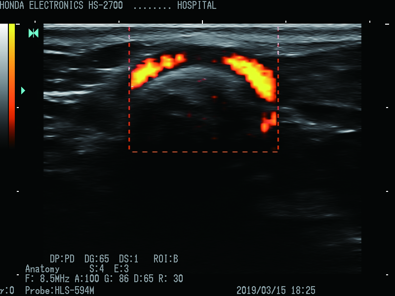 PD（功率多普勒） 探头：HLS-594M H-res: 解剖学