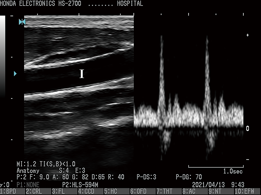 PW(脉冲多普勒) 探头：HLS-594M H-res：Anatomy