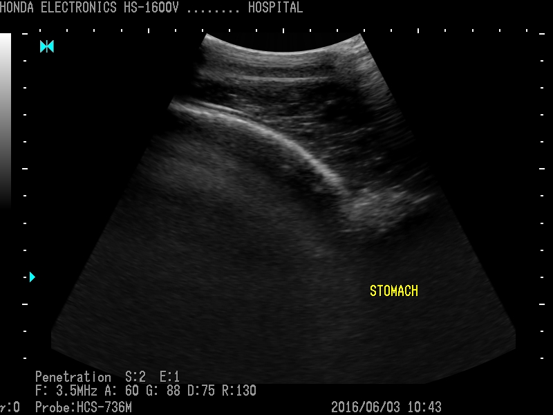 部分   ：右肾和12指肠 探头   ：HCS- 736M H-res ： Penetration