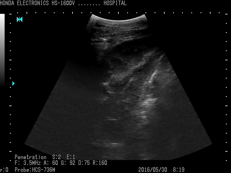 部分   ：右肾和12指肠 探头   ：HCS- 736M H-res ： Penetration