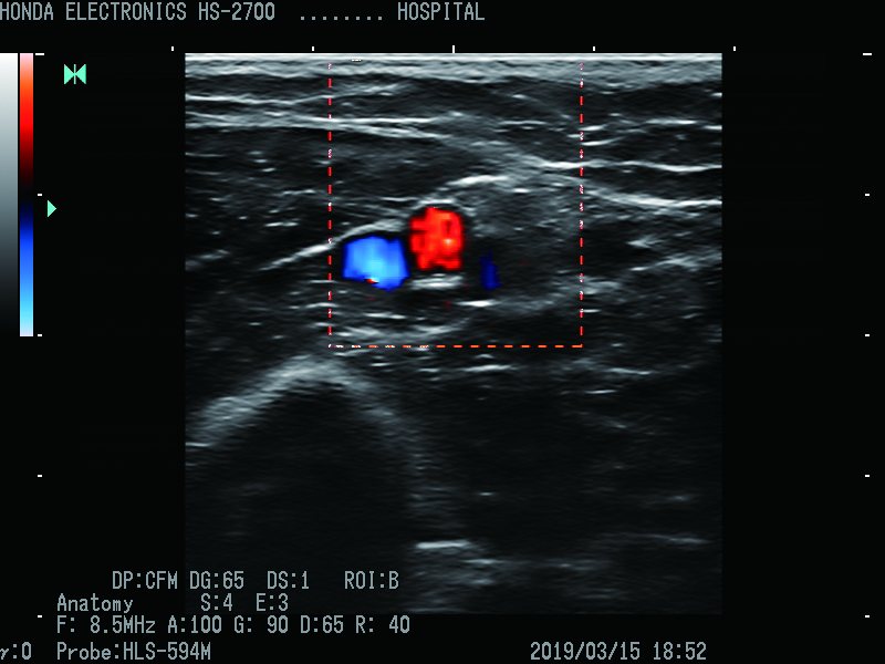 CFM(色流图) 探头：HLS-594M H-res：Anatomy