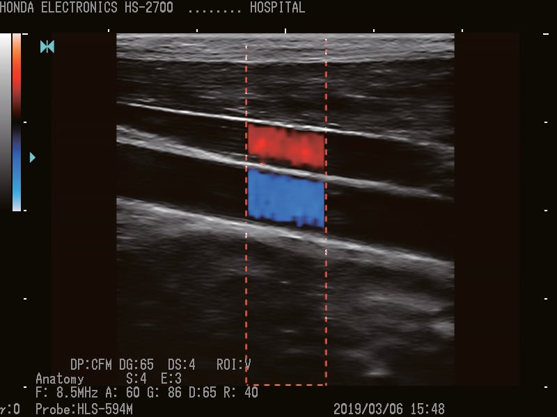 Vertical(垂直) 探头：HLS-594M H-res ：Anatomy